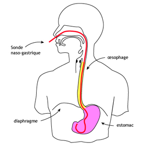 Boulimie_sonde_gastrique.jpg