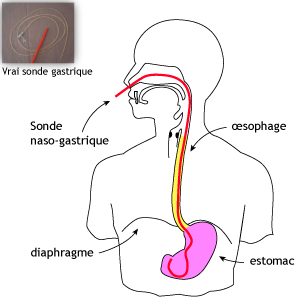 Boulimie_sonde_nasogastrique.jpg